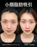 山本医師の🎀小顔整形🎀 90日後 サムネイル用