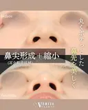 鼻尖形成（耳介軟骨移植）＋鼻尖縮小＋眉間鼻筋オーダーメイドプロテーゼ｜丸い鼻先を美しく✨ after画像 サムネイル用