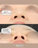 鼻尖形成（耳介軟骨移植）＋鼻尖縮小＋眉間鼻筋オーダーメイドプロテーゼ｜丸い鼻先を美しく✨ after画像 サムネイル用