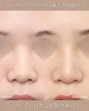 鼻尖形成（耳介軟骨移植）＋鼻尖縮小＋眉間鼻筋オーダーメイドプロテーゼ｜丸い鼻先を美しく✨ after画像 サムネイル用