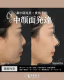 鼻中隔延長＋貴族手術｜中顔面発達✨ after画像 サムネイル用