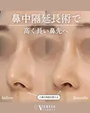 鼻中隔延長＋貴族手術｜中顔面発達✨ after画像 サムネイル用