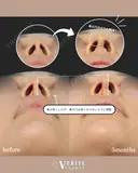 鼻中隔延長＋貴族手術｜中顔面発達✨ after画像 サムネイル用
