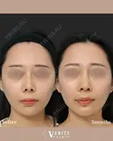 鼻中隔延長＋貴族手術｜中顔面発達✨ after画像 サムネイル用