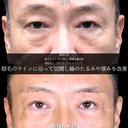 眉下リフト/クマ取り/脂肪注入(目の下・ゴルゴライン)/余剰皮膚切除 before画像 サムネイル用