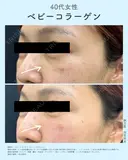 ベビーコラーゲン(ヒューマラジェン) before画像 サムネイル用
