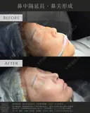 鼻中隔延長、鼻尖形成 before画像 サムネイル用