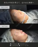 鼻中隔延長、鼻尖形成 after画像 サムネイル用