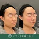 自然なヒアルロン酸💉🎀ヒアルロン酸（ほうれい線・ゴルゴ・鼻）形成外科専門医がご対応✨ before画像 サムネイル用