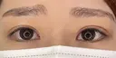 【二重埋没法】自然癒着法 after画像 サムネイル用