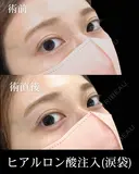 ヒアルロン酸注入 after画像 サムネイル用
