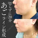 【切らずに20分】あごライン形成 after画像 サムネイル用
