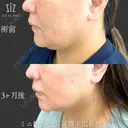 【切らずに20分】あごライン形成 before画像 サムネイル用