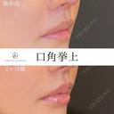 口角挙上 before画像 サムネイル用