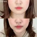 切らない顎形成 3D Eライン after画像 サムネイル用