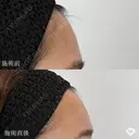 おでこ・こめかみのデザイン注射（ヒアルロン酸） after画像 サムネイル用