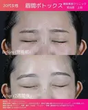 アラガン製ボトックス before画像 サムネイル用
