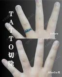 タトゥー除去（切除法）のご紹介💁🏻‍♀️ before画像 サムネイル用