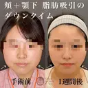脂肪吸引（頬＋顎下） after画像 サムネイル用