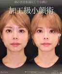 糸リフト ・エラボトックス 30日後 サムネイル用