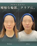 アルテミスリフト(糸リフト) before画像 サムネイル用