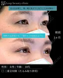 二重前切開＋たるみ取り併用 after画像 サムネイル用