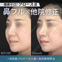 他院鼻プロテーゼ入替＋他院異物除去＋鼻フルコース［クローズ法］（鼻複合自家組織移植術） after画像 サムネイル用