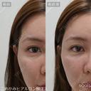 ヒアルロン酸｜ニューラミス｜1cc｜涙袋・鼻・あご・ゴルゴラインなどから選べる after画像 サムネイル用