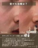 ポテンツァマックーム導入 1回 before画像 サムネイル用