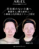 鼻翼挙上/鼻孔縁挙上/小鼻縮小内外側法(フラップ固定) 90日後 サムネイル用