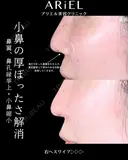 鼻翼挙上/鼻孔縁挙上/小鼻縮小内外側法(フラップ固定) before画像 サムネイル用