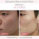 ほくろ除去 before画像 サムネイル用