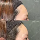 ヒアルロン酸注入（額） before画像 サムネイル用