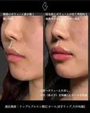 唇ヒアルロン酸 before画像 サムネイル用
