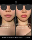 唇ヒアルロン酸 after画像 サムネイル用