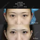 目頭切開＋眼瞼下垂症手術＋眉下切開＋グラマラスライン形成 before画像 サムネイル用