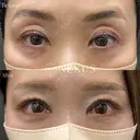 眼瞼下垂＋目頭切開 after画像 サムネイル用