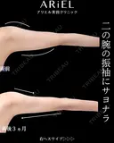 二の腕　肩　脂肪吸引 90日後 サムネイル用
