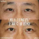 下瞼結膜側ハムラ法 after画像 サムネイル用