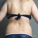腰のベイザー脂肪吸引 before画像 サムネイル用