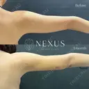 脂肪吸引（二の腕） before画像 サムネイル用