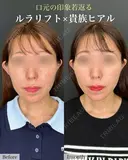 ルラリフト×貴族フィラー before画像 サムネイル用