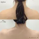肩ボトックス after画像 サムネイル用
