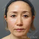 顔のSRF注入 before画像 サムネイル用