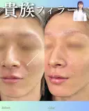貴族フィラー before画像 サムネイル用