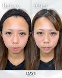 顎のヒアルロン酸注入 before画像 サムネイル用