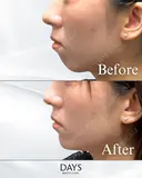 顎のヒアルロン酸注入 after画像 サムネイル用