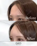 額のヒアルロン酸注入 before画像 サムネイル用