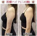 ボディハイフ after画像 サムネイル用