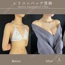 シリコンバッグ豊胸 before画像 サムネイル用